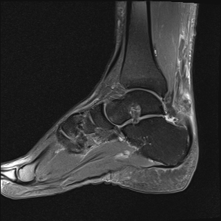 File:Achilles tendon tear (Radiopaedia 77615-89819 Sagittal PD fat sat 12).jpg