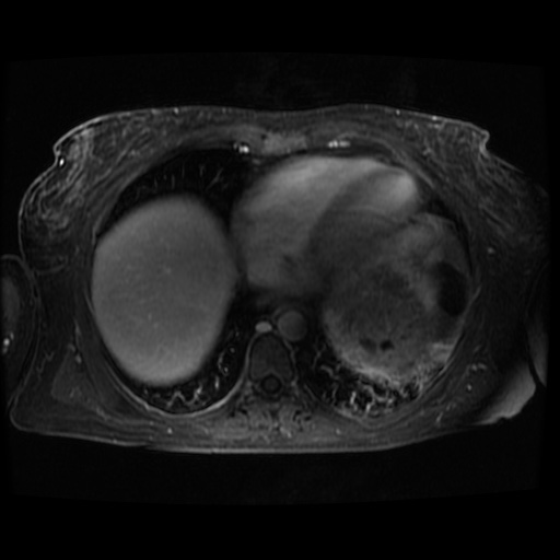 Acinar cell carcinoma of the pancreas (Radiopaedia 75442-86668 D 135).jpg