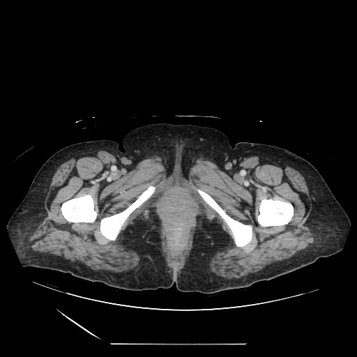 Acinar cell carcinoma of the pancreas (Radiopaedia 75442-86669 Axial C+ portal venous phase 156).jpg