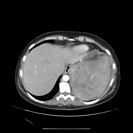 Acinar cell carcinoma of the pancreas (Radiopaedia 75442-86669 Axial C+ portal venous phase 18).jpg