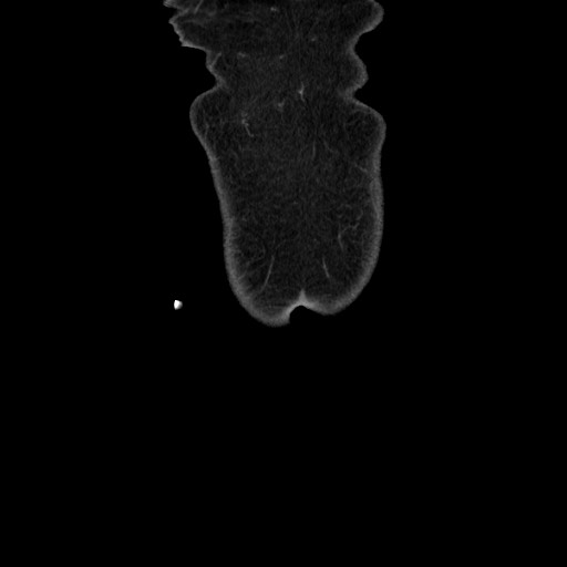 Acinar cell carcinoma of the pancreas (Radiopaedia 75442-86669 Coronal C+ portal venous phase 6).jpg