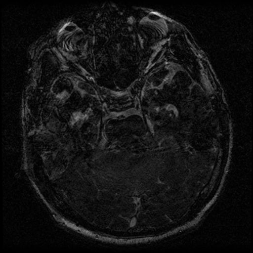 File:Acoustic schwannoma (Radiopaedia 39170-41387 Axial FIESTA 106).png