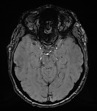 Acoustic schwannoma (Radiopaedia 50846-56358 Axial SWI 36).png