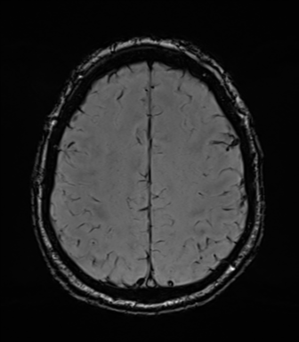 File:Acoustic schwannoma (Radiopaedia 50846-56358 Axial SWI 71).png