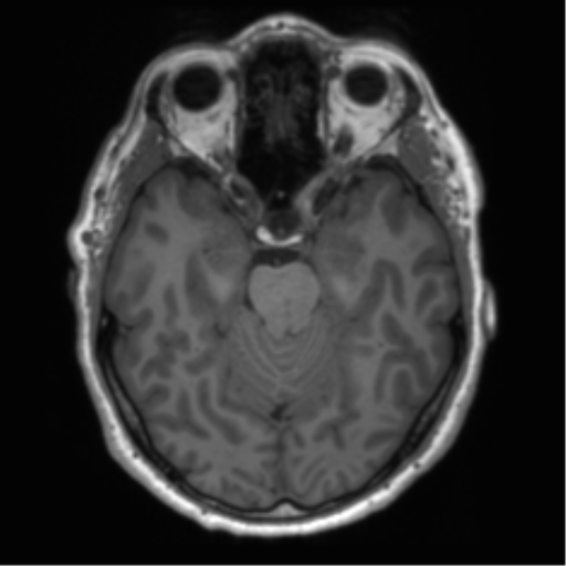 File:Acoustic schwannoma (Radiopaedia 50846-56358 Axial T1 39).png