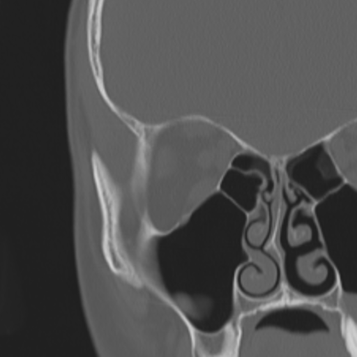 Acoustic schwannoma - eroding petrous apex (Radiopaedia 39674-42002 Coronal bone window 18).png