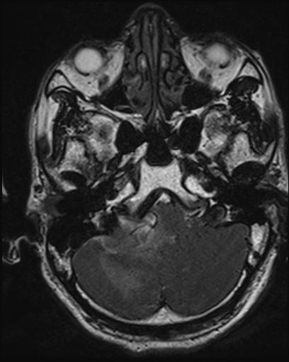 Acoustic schwannoma - probable (Radiopaedia 20386-20292 Axial T1 30).jpg
