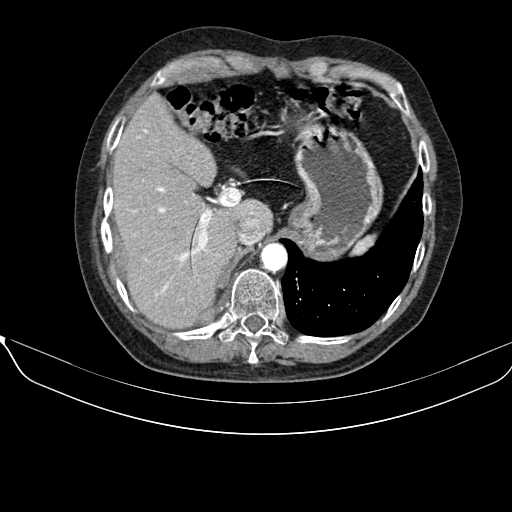 File:Acquired adrenal hyperplasia - due to thymic carcinoid tumor (Radiopaedia 21269-21184 C+ arterial phase 15).jpg
