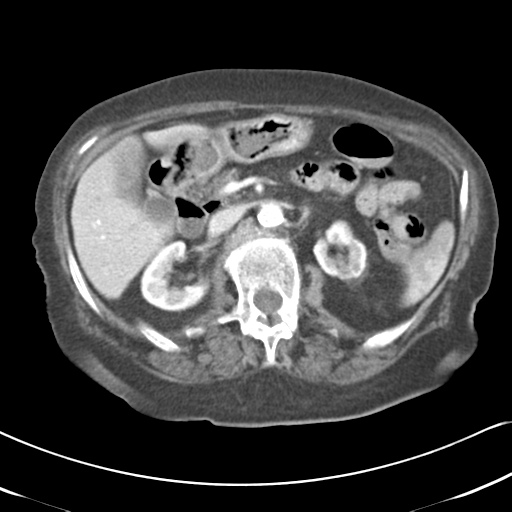 Active bleeding from duodenal ulcer with embolization (Radiopaedia 34216-35481 C 23).png