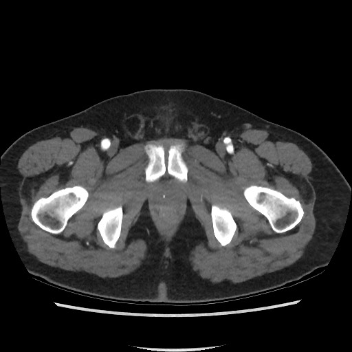 File:Active colonic bleed on CT (Radiopaedia 49765-55025 Axial C+ arterial phase 85).jpg