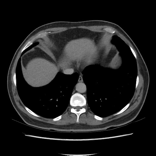 File:Active colonic bleed on CT (Radiopaedia 49765-55025 Axial C+ delayed 9).jpg