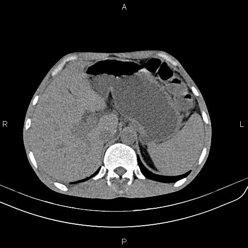 Active crohn disease (Radiopaedia 87133-103397 Axial non-contrast 22).jpg