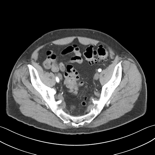 File:Active diverticular hemorrhage (Radiopaedia 39415-41725 Axial C+ arterial phase 56).png