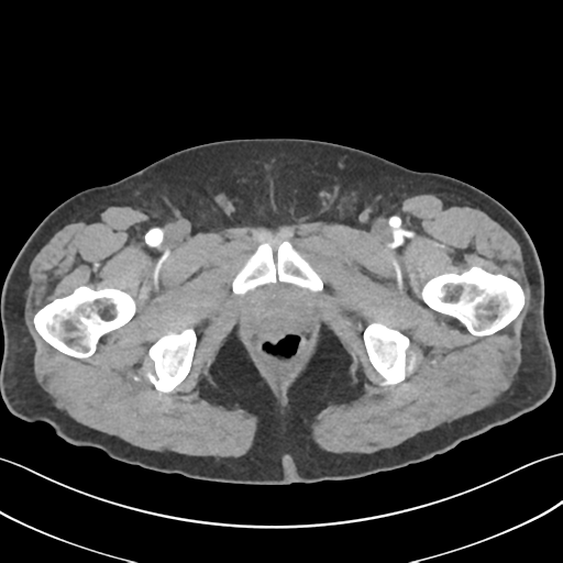 File:Active diverticular hemorrhage (Radiopaedia 39415-41725 Axial C+ arterial phase 74).png