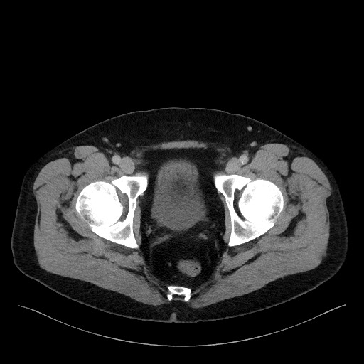 Acute-on-chronic pancreatitis (Radiopaedia 67286-76656 Axial C+ portal venous phase 78).jpg
