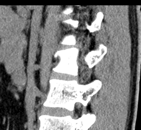 Acute L1 burst compression fracture (Radiopaedia 34430-35755 E 62).png