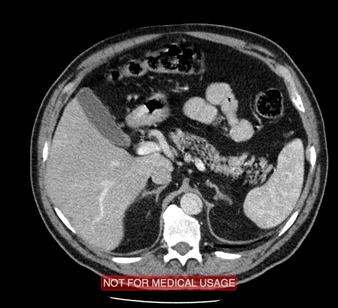 Acute aortic dissection - Stanford type A (Radiopaedia 40661-43285 Axial C+ portal venous phase 77).jpg