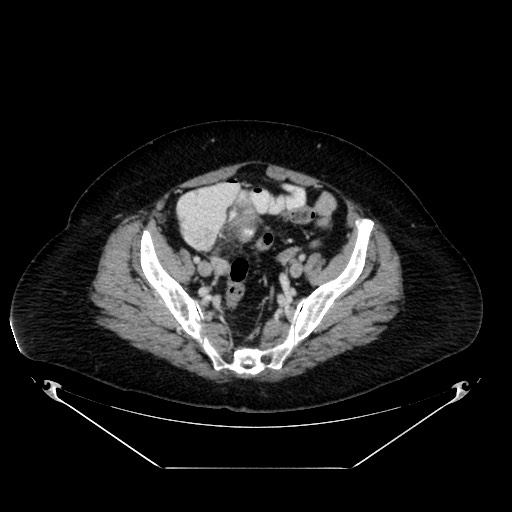 File:Acute appendicitis, heterotaxy syndrome (Radiopaedia 66884-76202 Axial 56).jpg