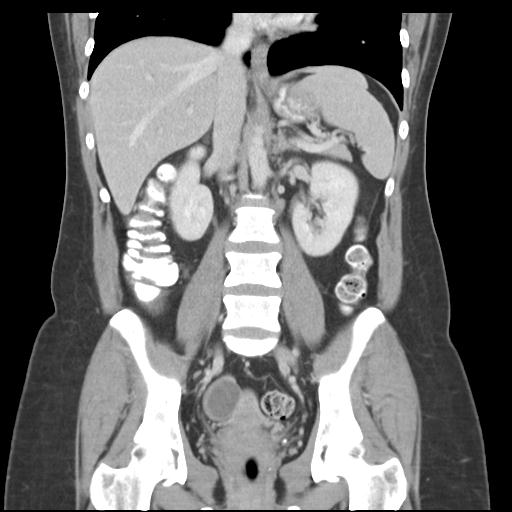 Acute appendicitis (Radiopaedia 30297-30934 Coronal C+ portal venous phase 27).jpg