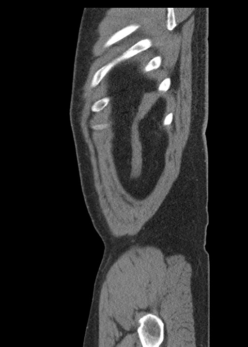 Acute appendicitis (Radiopaedia 48511-53463 Sagittal C+ portal venous phase 119).jpg