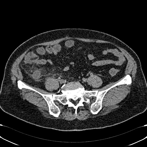 Acute appendicitis (Radiopaedia 58627-65818 Axial non-contrast 62).jpg