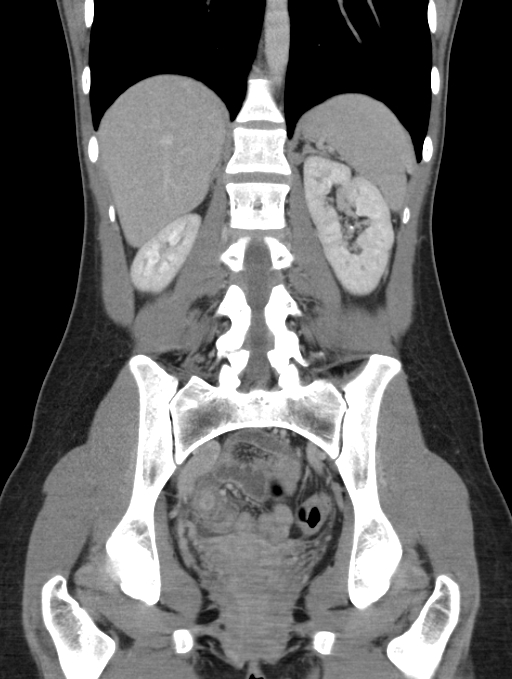 Acute appendicitis (Radiopaedia 62608-70901 Coronal C+ portal venous phase 37).jpg