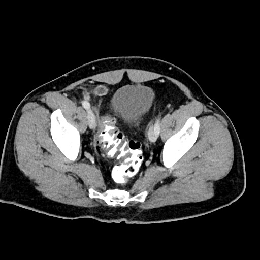 Acute appendicitis (Radiopaedia 77016-88960 Axial C+ portal venous phase 122).jpg