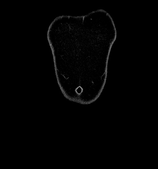 Acute appendicitis (Radiopaedia 77016-88960 Coronal C+ portal venous phase 10).jpg