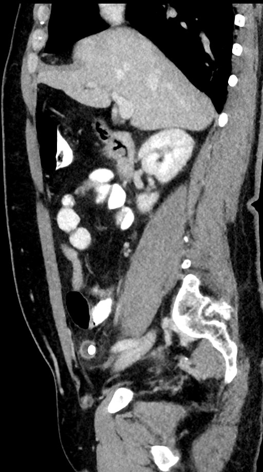 Acute appendicitis (Radiopaedia 77016-88960 Sagittal C+ portal venous phase 73).jpg