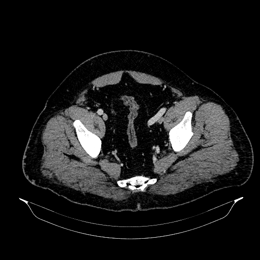 Acute appendicitis (Radiopaedia 79950-93224 Axial C+ portal venous phase 89).jpg
