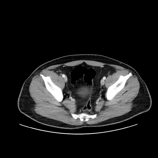 File:Acute appendicitis and COVID 19 pneumonia (Radiopaedia 76604-88380 Axial C+ portal venous phase 72).jpg