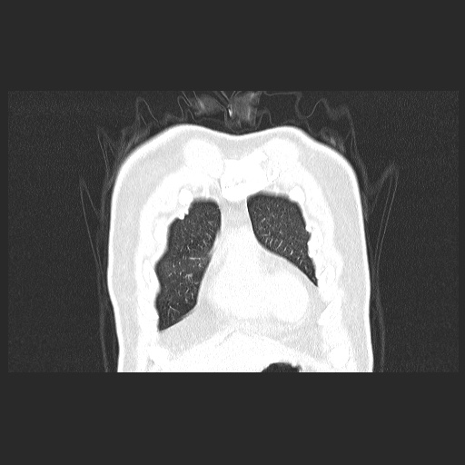 Acute appendicitis and COVID 19 pneumonia (Radiopaedia 76604-88380 G 11).jpg