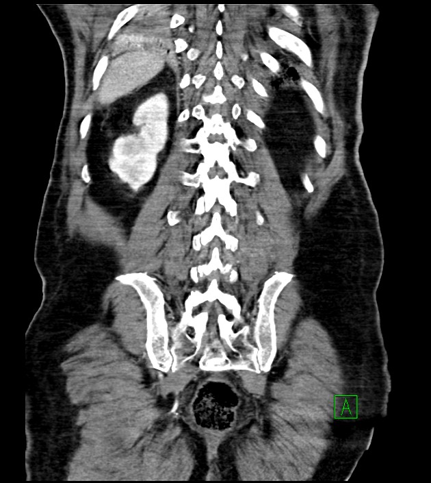 Acute arterial mesenteric ischemia (Radiopaedia 78238-90828 Coronal C+ portal venous phase 74).jpg