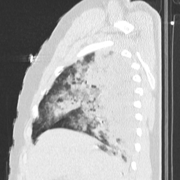 Acute aspiration pneumonitis (Radiopaedia 33605-34703 Sagittal lung window 24).jpg