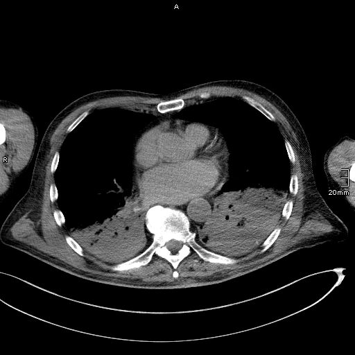 Acute aspiration pneumonitis (Radiopaedia 55642-62166 Axial liver window 38).jpg