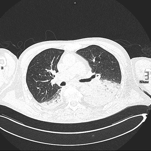Acute aspiration pneumonitis (Radiopaedia 55642-62166 Axial lung window 72).jpg