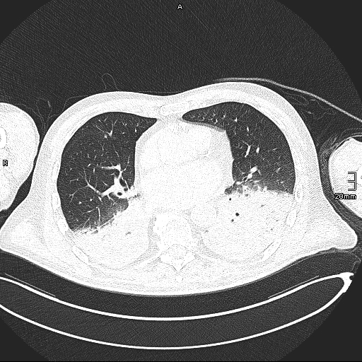 Acute aspiration pneumonitis (Radiopaedia 55642-62166 Axial lung window 91).jpg