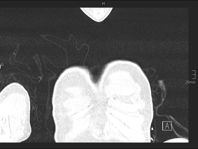 Acute aspiration pneumonitis (Radiopaedia 55642-62166 Coronal lung window 1).jpg