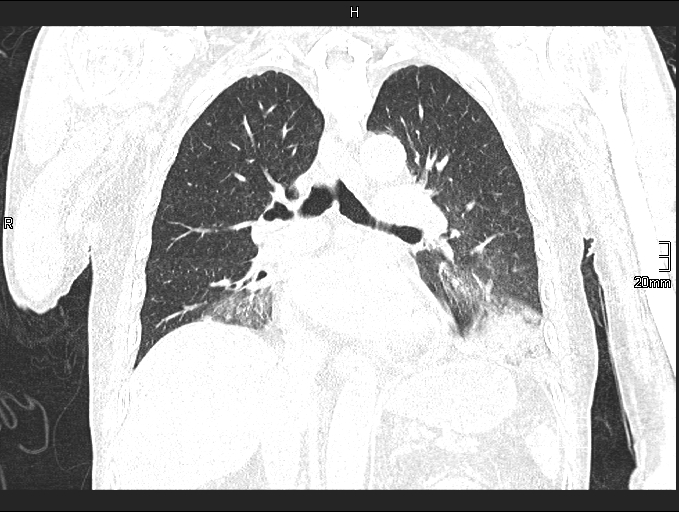 File:Acute aspiration pneumonitis (Radiopaedia 55642-62166 Coronal lung window 57).jpg