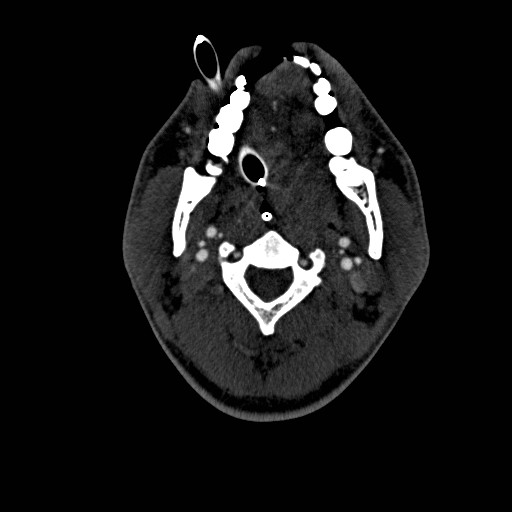 Acute basilar artery occlusion (Radiopaedia 43582-46985 Axial C+ arterial phase 143).jpg