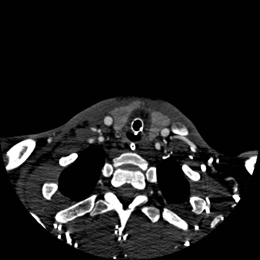 Acute basilar artery occlusion (Radiopaedia 43582-46985 Axial C+ arterial phase 280).jpg