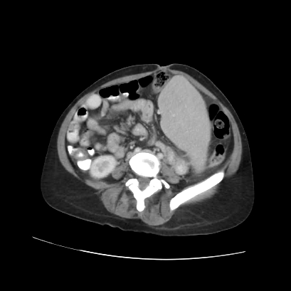 Acute calculous cholecystitis in patient with osteopetrosis (Radiopaedia 77871-90159 Axial C+ portal venous phase 53).jpg
