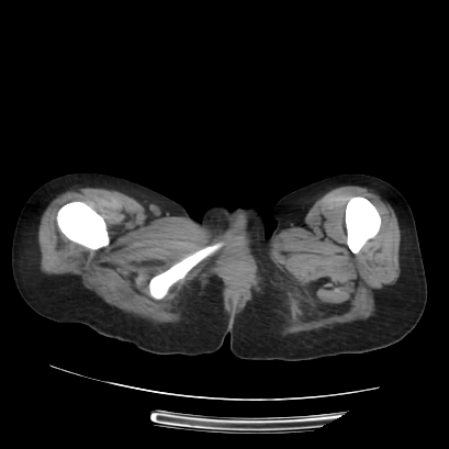 File:Acute calculous cholecystitis in patient with osteopetrosis (Radiopaedia 77871-90159 Axial non-contrast 86).jpg