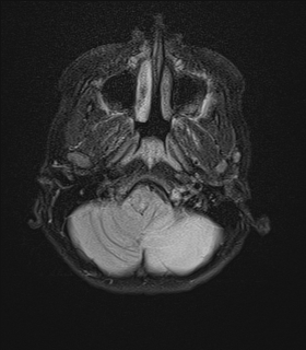 File:Acute cerebellar ataxia (Radiopaedia 61487-69446 Axial FLAIR 2).jpg