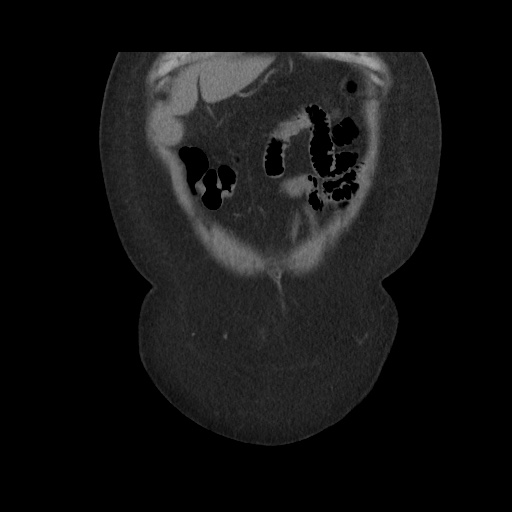 Acute cholecystitis with tensile fundus sign (Radiopaedia 71394-81723 Coronal non-contrast 27).jpg