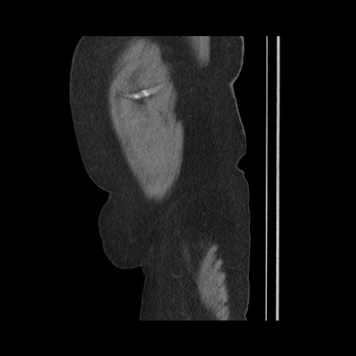 Acute cholecystitis with tensile fundus sign (Radiopaedia 71394-81723 Sagittal non-contrast 152).jpg