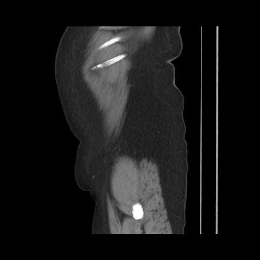 Acute cholecystitis with tensile fundus sign (Radiopaedia 71394-81723 Sagittal non-contrast 33).jpg