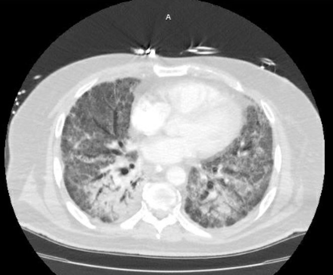 Acute cor pulmonale (ultrasound) (Radiopaedia 83508-98818 Axial lung window 53).jpg
