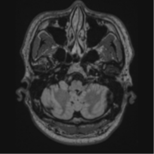 Acute disseminated encephalomyelitis (ADEM)- Anti-NMDA receptor encephalitis (Radiopaedia 54920-61201 Axial FLAIR 11).png