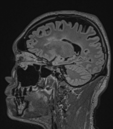 File:Acute disseminated encephalomyelitis (ADEM)- Anti-NMDA receptor encephalitis (Radiopaedia 54920-61201 Sagittal FLAIR 34).png